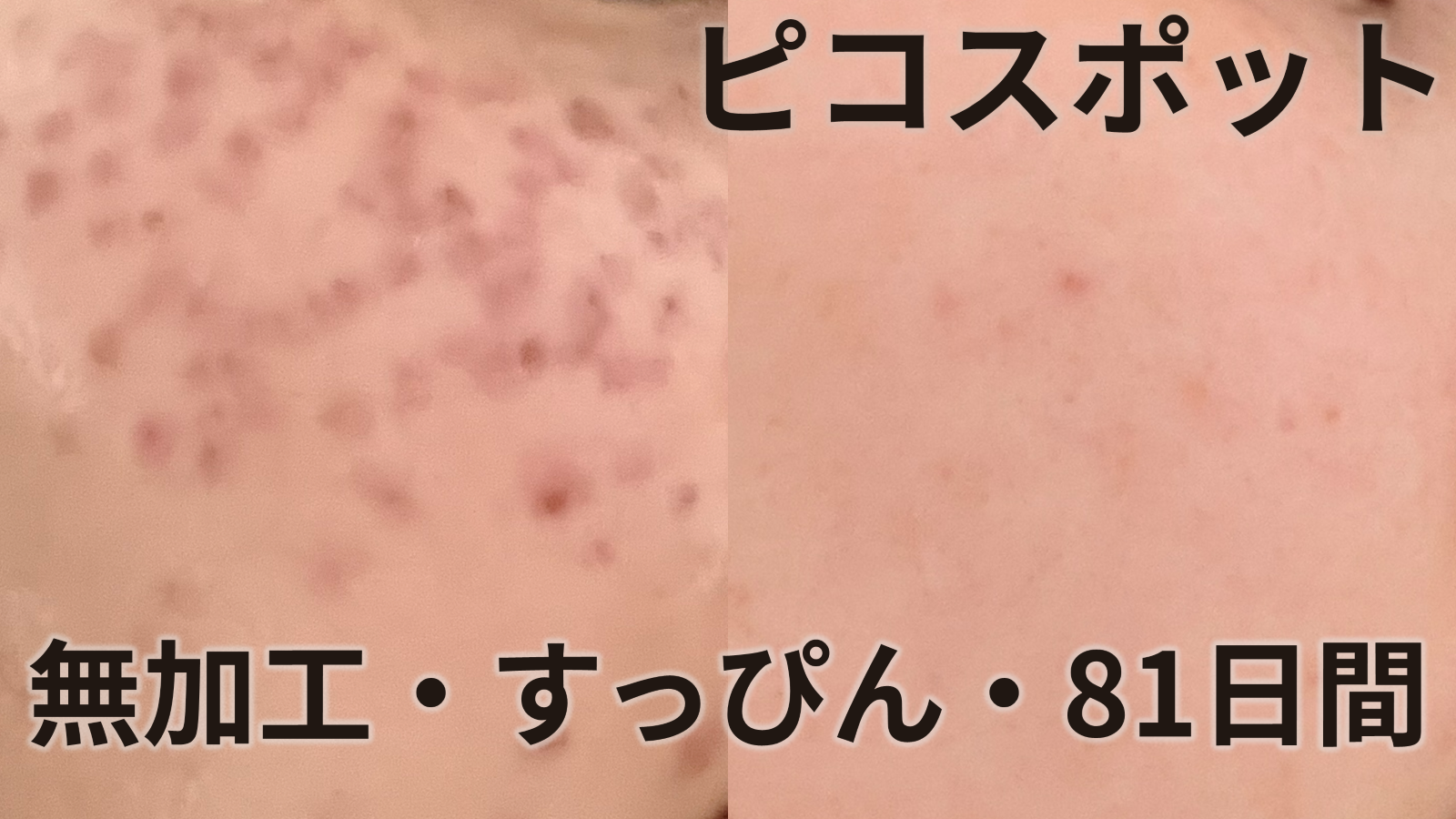 ピコスポット　無加工・すっぴん・81日間